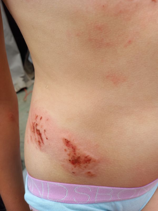 Heidis mountain biking injuries (4)