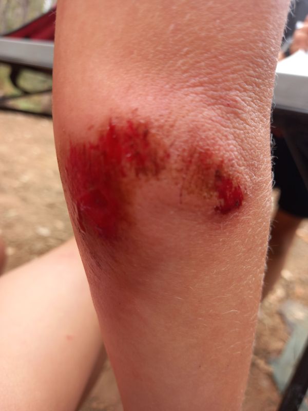 Heidis mountain biking injuries (6)